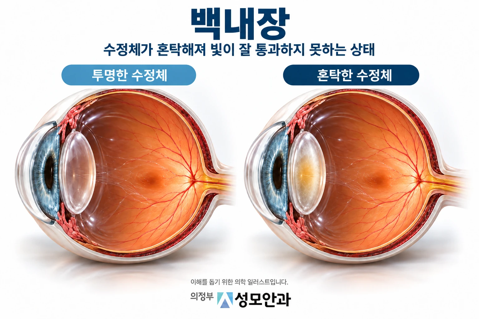 백내장 수정체 혼탁을 설명한 일러스트