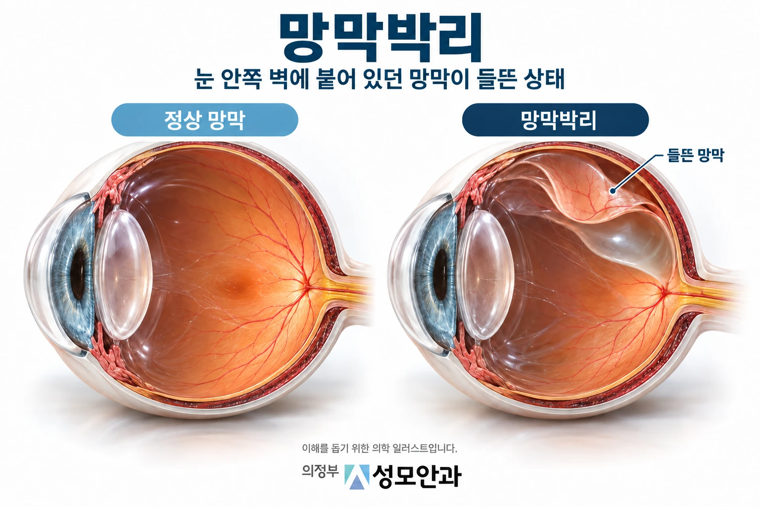 망막박리의 구조를 설명한 일러스트